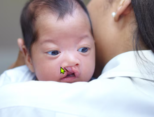 Cleft Lip and Palete Repair