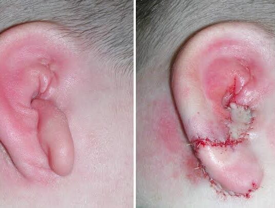 ear recnstructon