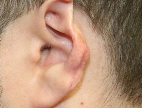 ear-reconstruction-p07-side-1024x628