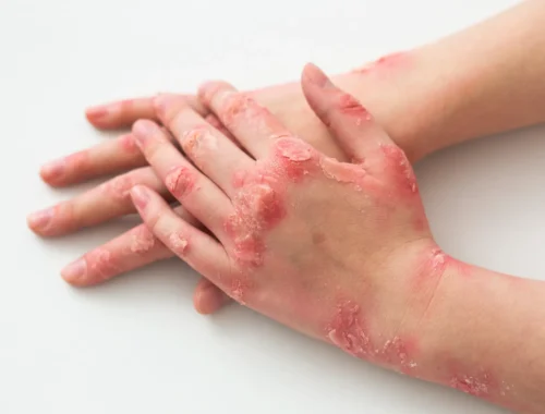 hands-patient-suffering-from-psoriasis