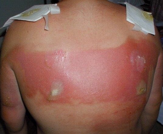 minor-burn-back