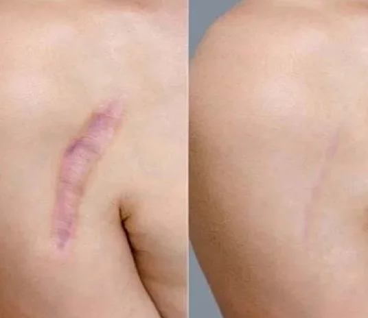 Scar-Revision-Surgery