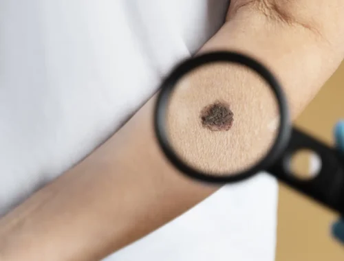 high-angle-magnifying-glass-mole